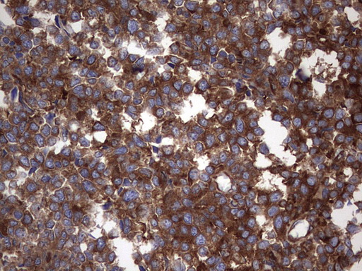 NUMB Antibody - IHC of paraffin-embedded Human melanoma tissue using anti-NUMB mouse monoclonal antibody. (Heat-induced epitope retrieval by 1 mM EDTA in 10mM Tris, pH8.5, 120°C for 3min).