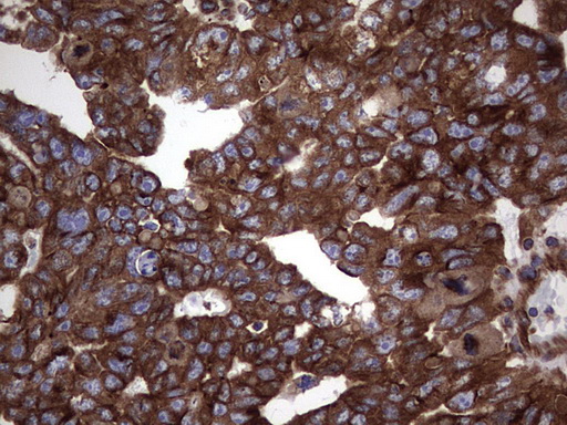 NUMB Antibody - IHC of paraffin-embedded Human testicular cancer tissue using anti-NUMB mouse monoclonal antibody. (Heat-induced epitope retrieval by 1 mM EDTA in 10mM Tris, pH8.5, 120°C for 3min).