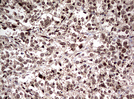 NUMB Antibody - IHC of paraffin-embedded Human melanoma tissue using anti-NUMB mouse monoclonal antibody. (Heat-induced epitope retrieval by 10mM citric buffer, pH6.0, 120°C for 3min).