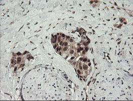NUMB Antibody - IHC of paraffin-embedded Adenocarcinoma of Human breast tissue using anti-NUMB mouse monoclonal antibody.
