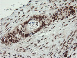 NUMB Antibody - IHC of paraffin-embedded Adenocarcinoma of Human colon tissue using anti-NUMB mouse monoclonal antibody.