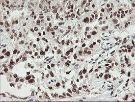 NUMB Antibody - IHC of paraffin-embedded Carcinoma of Human kidney tissue using anti-NUMB mouse monoclonal antibody.
