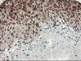 NUMB Antibody - IHC of paraffin-embedded Carcinoma of Human lung tissue using anti-NUMB mouse monoclonal antibody.