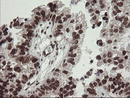 NUMB Antibody - IHC of paraffin-embedded Adenocarcinoma of Human ovary tissue using anti-NUMB mouse monoclonal antibody.