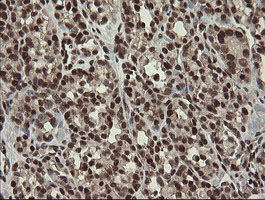NUMB Antibody - IHC of paraffin-embedded Carcinoma of Human thyroid tissue using anti-NUMB mouse monoclonal antibody.