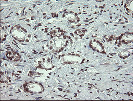 NUMB Antibody - IHC of paraffin-embedded Carcinoma of Human prostate tissue using anti-NUMB mouse monoclonal antibody.