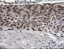 NUMB Antibody - IHC of paraffin-embedded Carcinoma of Human bladder tissue using anti-NUMB mouse monoclonal antibody.