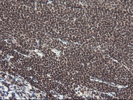 NUMB Antibody - IHC of paraffin-embedded Human lymphoma tissue using anti-NUMB mouse monoclonal antibody.