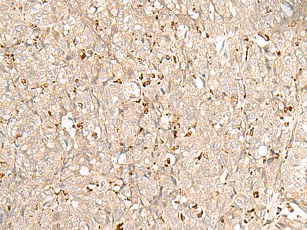 NUP210 / gp210 Antibody - Immunohistochemistry of paraffin-embedded Human ovarian cancer tissue  using NUP210 Polyclonal Antibody at dilution of 1:30(×200)