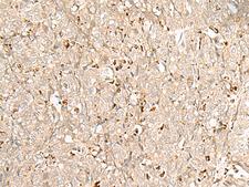 NUP210 / gp210 Antibody - Immunohistochemistry of paraffin-embedded Human ovarian cancer tissue  using NUP210 Polyclonal Antibody at dilution of 1:30(×200)