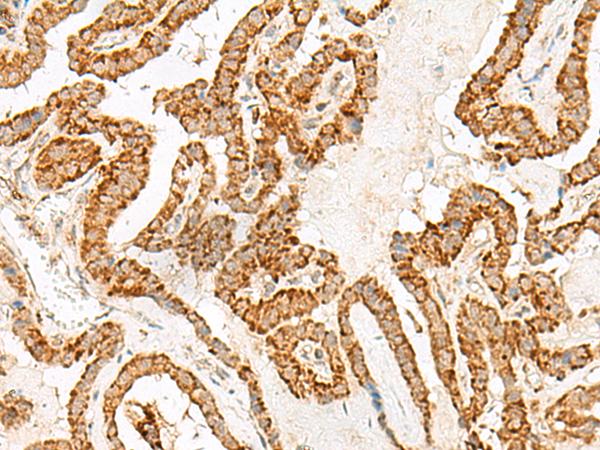 NUP210 / gp210 Antibody - Immunohistochemistry of paraffin-embedded Human thyroid cancer tissue  using NUP210 Polyclonal Antibody at dilution of 1:30(×200)