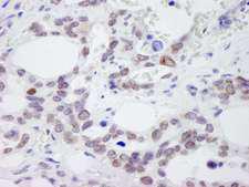 NUP214 / CAN Antibody - Detection of Human NUP214 by Immunohistochemistry. Sample: FFPE section of human ovarian carcinoma. Antibody: Affinity purified rabbit anti-NUP214 used at a dilution of 1:100. Detection: DAB staining using anti-Rabbit IHC antibody at a dilution of 1:100.