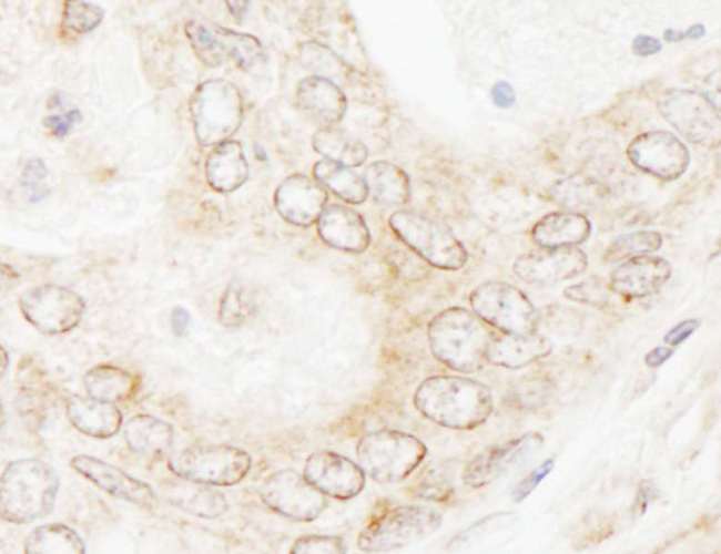 NUP35 / NUP53 Antibody - Detection of Human NUP35 by Immunohistochemistry. Sample: FFPE section of human prostate carcinoma. Antibody: Affinity purified rabbit anti-NUP35 used at a dilution of 1:1000 (1 ug/ml). Detection: DAB.