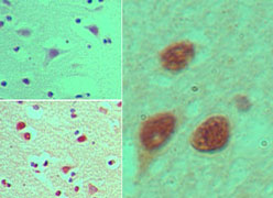 NUP35 / NUP53 Antibody - IHC of NUP35 in formalin-fixed, paraffin-embedded human brain tissue using an isotype control (top left) and Polyclonal Antibody to NUP35 (bottom left, right) at 5 ug/ml.