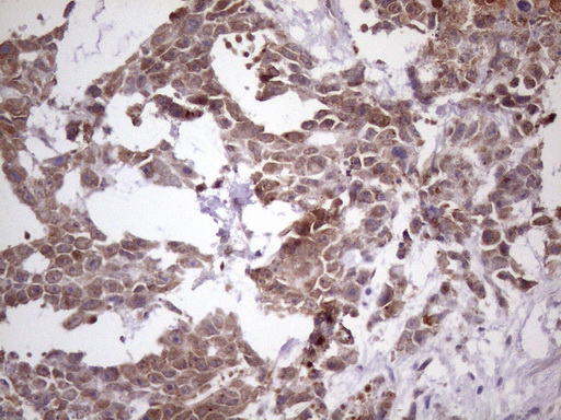 NUP43 Antibody - Immunohistochemical staining of paraffin-embedded Human testicular cancer tissue using anti-NUP43 mouse monoclonal antibody. (Heat-induced epitope retrieval by 1 mM EDTA in 10mM Tris, pH8.5, 120C for 3min. (1:150)