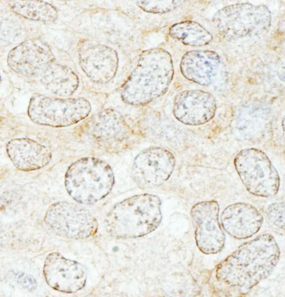 NUP50 Antibody - Detection of Human NUP50 by Immunohistochemistry. Sample: FFPE section of human breast carcinoma. Antibody: Affinity purified rabbit anti-NUP50 used at a dilution of 1:1000 (1 ug/ml). Detection: DAB.