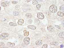 NUP50 Antibody - Detection of Human NUP50 by Immunohistochemistry. Sample: FFPE section of human breast carcinoma. Antibody: Affinity purified rabbit anti-NUP50 used at a dilution of 1:500.