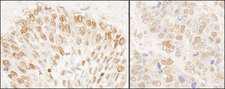 NUP50 Antibody - Detection of Human and Mouse NUP50 by Immunohistochemistry. Sample: FFPE section of human prostate carcinoma (left) and mouse teratoma (right). Antibody: Affinity purified rabbit anti-NUP50 used at a dilution of 1:200 (1 ug/ml). Detection: DAB.