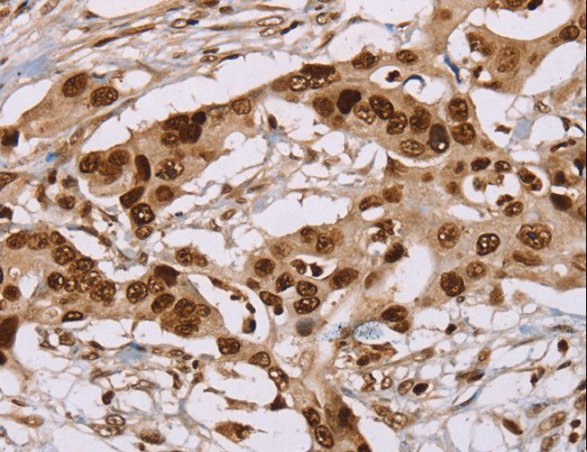 NUP50 Antibody - Immunohistochemistry of paraffin-embedded Human colon cancer using NUP50 Polyclonal Antibody at dilution of 1:30.