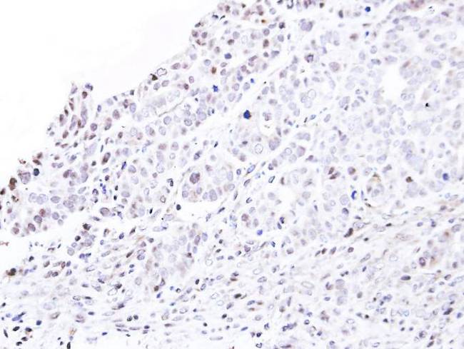 NUP62 Antibody - IHC of paraffin-embedded NCIN87 xenograft using nucleoporin p62 antibody at 1:500 dilution.