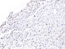 NUP62 Antibody - IHC of paraffin-embedded NCIN87 xenograft using nucleoporin p62 antibody at 1:500 dilution.