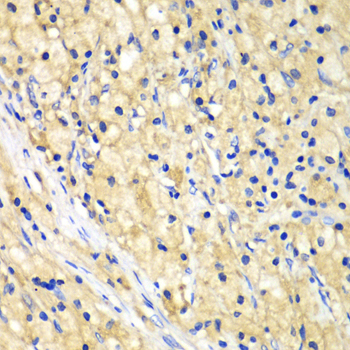 NUP62 Antibody - Immunohistochemistry of paraffin-embedded human lung cancer tissue.