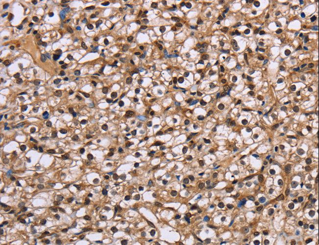 NUP62 Antibody - Immunohistochemistry of paraffin-embedded Human prostate cancer using NUP62 Polyclonal Antibody at dilution of 1:50.