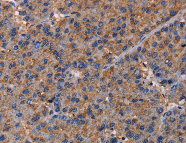 NUP62 Antibody - Immunohistochemistry of paraffin-embedded Human liver cancer using NUP62 Polyclonal Antibody at dilution of 1:40.
