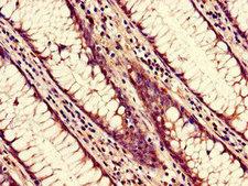 NUP85 / Pericentrin 1 Antibody - Immunohistochemistry of paraffin-embedded human colon cancer using NUP85 Antibody at dilution of 1:100