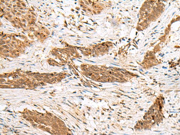 NUPL1 Antibody - Immunohistochemistry of paraffin-embedded Human esophagus cancer tissue  using NUP58 Polyclonal Antibody at dilution of 1:50(×200)