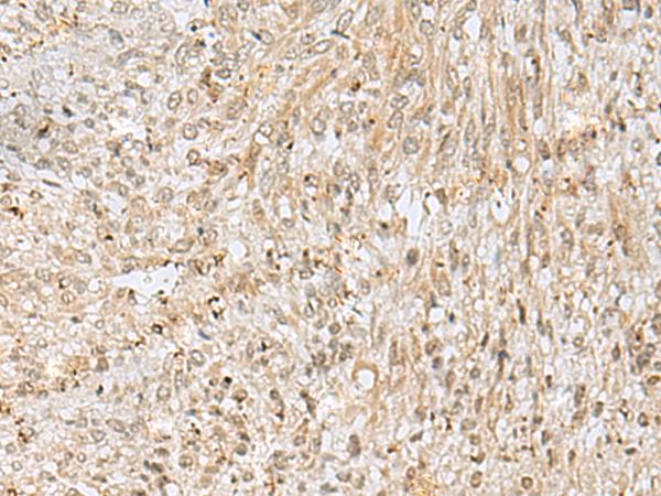 NUPL1 Antibody - Immunohistochemistry of paraffin-embedded Human liver cancer tissue  using NUP58 Polyclonal Antibody at dilution of 1:50(×200)
