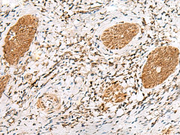 NUPL1 Antibody - Immunohistochemistry of paraffin-embedded Human esophagus cancer tissue  using NUP58 Polyclonal Antibody at dilution of 1:60(×200)