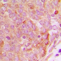 NUTF2 / PP15 Antibody - Immunohistochemical analysis of PP15 staining in human breast cancer formalin fixed paraffin embedded tissue section. The section was pre-treated using heat mediated antigen retrieval with sodium citrate buffer (pH 6.0). The section was then incubated with the antibody at room temperature and detected with HRP and DAB as chromogen. The section was then counterstained with hematoxylin and mounted with DPX.