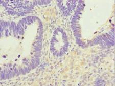 NUTF2 / PP15 Antibody - Immunohistochemistry of paraffin-embedded human ovarian cancer at dilution 1:100