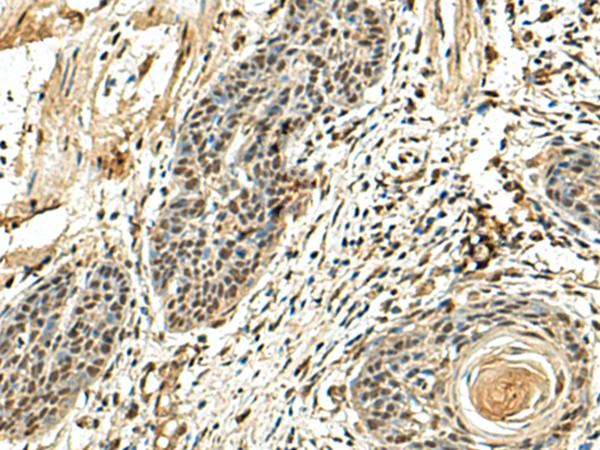 NUTF2 / PP15 Antibody - Immunohistochemistry of paraffin-embedded Human esophagus cancer tissue  using NUTF2 Polyclonal Antibody at dilution of 1:110(×200)