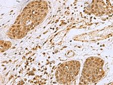 NVL Antibody - Immunohistochemistry of paraffin-embedded Human esophagus cancer tissue  using NVL Polyclonal Antibody at dilution of 1:80(×200)