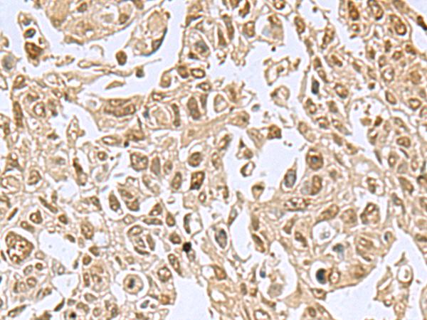 NVL Antibody - Immunohistochemistry of paraffin-embedded Human lung cancer tissue  using NVL Polyclonal Antibody at dilution of 1:80(×200)