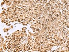 NVL Antibody - Immunohistochemistry of paraffin-embedded Human lung cancer tissue  using NVL Polyclonal Antibody at dilution of 1:70(×200)