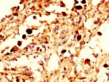 NXF / NPAS4 Antibody - Immunohistochemistry image at a dilution of 1:300 and staining in paraffin-embedded human melanoma cancer performed on a Leica BondTM system. After dewaxing and hydration, antigen retrieval was mediated by high pressure in a citrate buffer (pH 6.0) . Section was blocked with 10% normal goat serum 30min at RT. Then primary antibody (1% BSA) was incubated at 4 °C overnight. The primary is detected by a biotinylated secondary antibody and visualized using an HRP conjugated SP system.