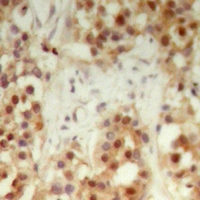 NXF3 Antibody - Immunohistochemical analysis of NXF3 staining in human breast cancer formalin fixed paraffin embedded tissue section. The section was pre-treated using heat mediated antigen retrieval with sodium citrate buffer (pH 6.0). The section was then incubated with the antibody at room temperature and detected with HRP and DAB as chromogen. The section was then counterstained with hematoxylin and mounted with DPX.
