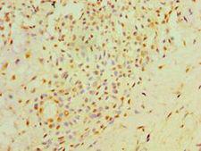 NXNL1 / TXNL6 Antibody - Immunohistochemistry of paraffin-embedded human breast cancer using antibody at 1:100 dilution.