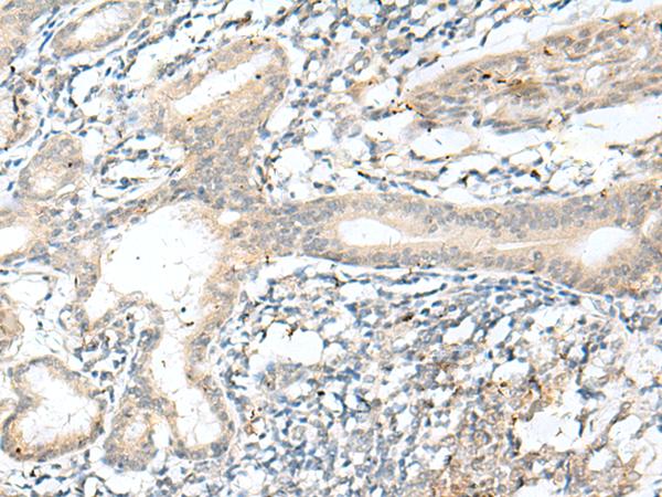 NXNL1 / TXNL6 Antibody - Immunohistochemistry of paraffin-embedded Human esophagus cancer tissue  using NXNL1 Polyclonal Antibody at dilution of 1:45(×200)