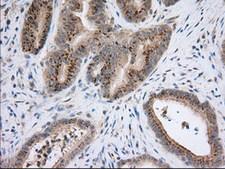 NXNL2 Antibody - Immunohistochemical staining of paraffin-embedded Adenocarcinoma of Human colon tissue using anti-NXNL2 mouse monoclonal antibody.