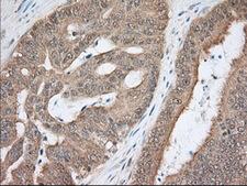 NXNL2 Antibody - Immunohistochemical staining of paraffin-embedded Adenocarcinoma of Human colon tissue using anti-NXNL2 mouse monoclonal antibody. (Dilution 1:50).