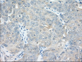 NXNL2 Antibody - IHC of paraffin-embedded Adenocarcinoma of Human ovary tissue using anti-NXNL2 mouse monoclonal antibody. (Dilution 1:50).