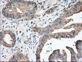 NXNL2 Antibody - IHC of paraffin-embedded Adenocarcinoma of Human colon tissue using anti-NXNL2 mouse monoclonal antibody. (Dilution 1:50).