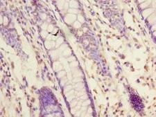 NXPE1 / FAM55A Antibody - Immunohistochemistry of paraffin-embedded human colon cancer using antibody at dilution of 1:100.