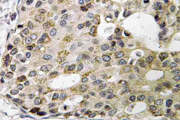 NXPH1 Antibody - IHC of Neurexophilin-1 (I109) pAb in paraffin-embedded human breast carcinoma tissue.