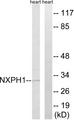 NXPH1 Antibody - Peptide - + Immunohistochemistry analysis of paraffin-embedded human breast carcinoma tissue, using NXPH1 antibody.