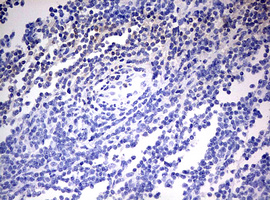 OAS2 Antibody - IHC of paraffin-embedded Human lymphoma tissue using anti-OAS2 mouse monoclonal antibody. (Heat-induced epitope retrieval by 10mM citric buffer, pH6.0, 120°C for 3min).
